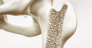 Disease Management Programm stärkt Gesundheitskompetenz von Osteoporose-Patienten Neues Disease Management Programm verbessert Versorgung von (Foto: AdobeStock - crevis 128396472)
